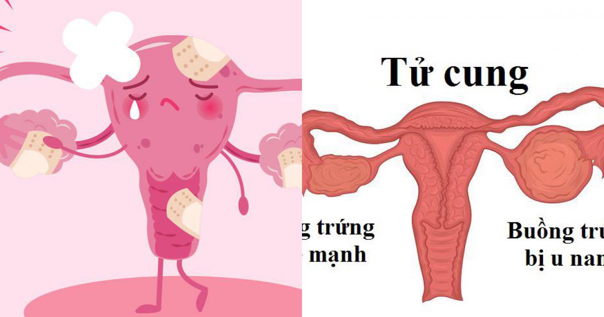 6 dấu hiệu u nang buồng trứng không phải ai cũng biết Kiến thức giới