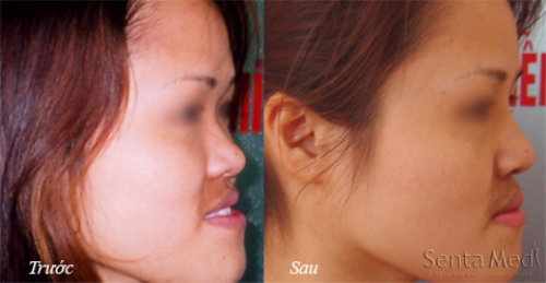 Nâng mũi hợp với đường cong sinh lý - Hình 2