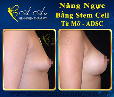 Nâng ngực, độn mông không dùng túi bằng Stem Cell - Hình 2