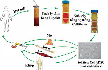 Nâng ngực, độn mông không dùng túi bằng Stem Cell - Hình 1