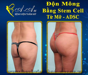 Nâng ngực, độn mông không dùng túi bằng Stem Cell - Hình 3