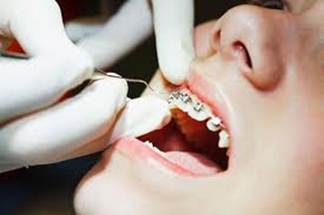 Niềng răng - giải pháp cho hàm răng đẹp - Hình 1