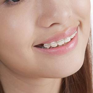 Niềng răng - giải pháp cho hàm răng đẹp - Hình 2