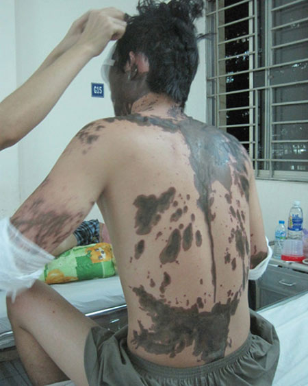 Lời kể của người bị bạn đổ axit vào mắt - Hình 1