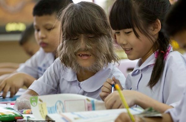 10 căn bệnh quái dị và đáng sợ nhất trên thế giới - Hình 10
