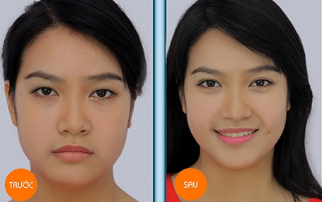 Sửa mắt một mí đẹp giống diễn viên Hàn - Hình 3