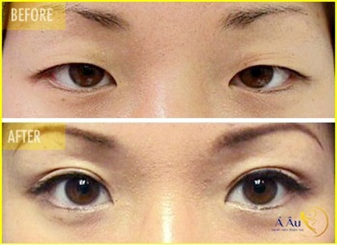 Phương pháp nhấn mí Hàn Quốc - Hình 2