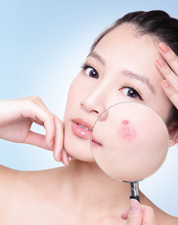 Các loại mụn thường gặp và cách nhận biết - Hình 1