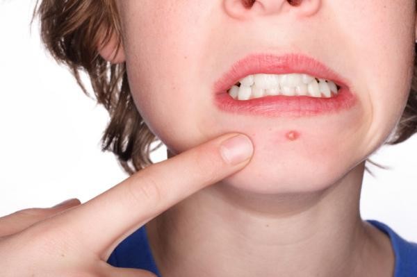 Các loại mụn thường gặp và cách nhận biết - Hình 4
