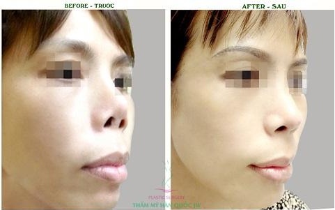 Giải pháp cho chiếc mũi ngắn, hếch - Hình 1