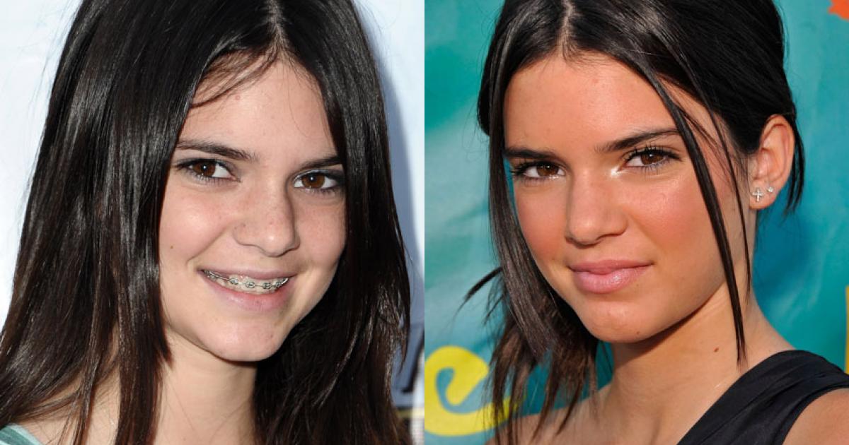 Kendall Jenner with Braces: See her Transformation and Stunning Results!