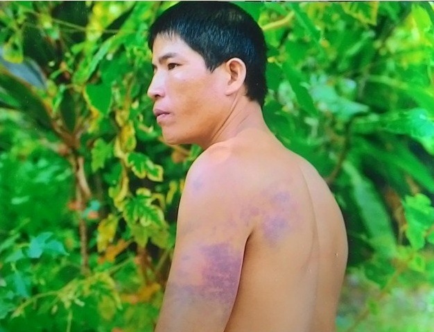 Phó trưởng công an xã đánh dân bầm tím - Hình 1