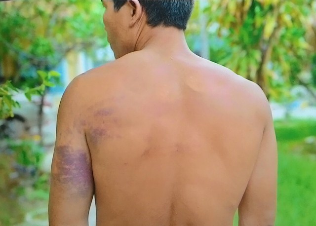 Phó trưởng công an xã đánh dân bầm tím - Hình 2
