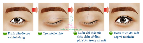 Nhấn mí có tồn tại vĩnh viễn hay không? - Hình 2