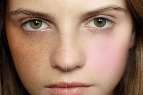 Thoát khỏi muộn phiền vì nám da - Hình 1