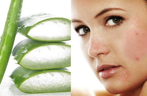 Bật mí cách trị mụn trứng cá tận gốc cho làn da khô - Hình 2