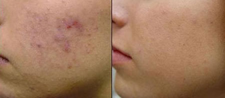 Cách điều trị tận gốc mụn trứng cá và sẹo thâm? - Hình 1