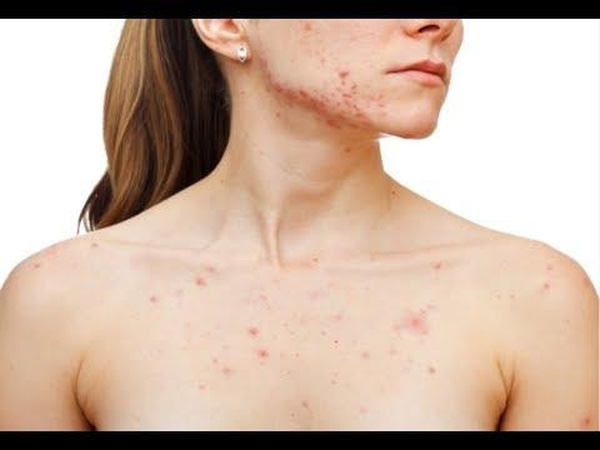 Tổng hợp bí kíp giúp chặn đứng đường quay lại của mụn trên cơ thể - Hình 4