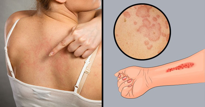 Cứ mỗi khi gió lạnh tràn về, cư dân mạng lại kêu than căn bệnh gây ngứa ngáy khắp cơ thể này - Hình 2