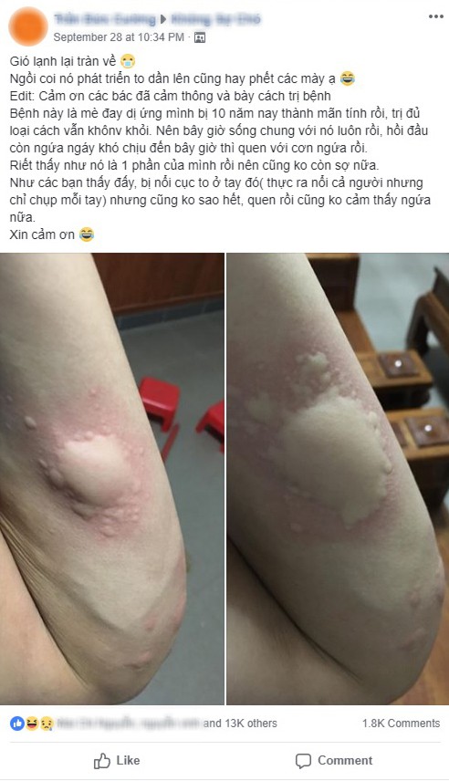 Cứ mỗi khi gió lạnh tràn về, cư dân mạng lại kêu than căn bệnh gây ngứa ngáy khắp cơ thể này - Hình 1