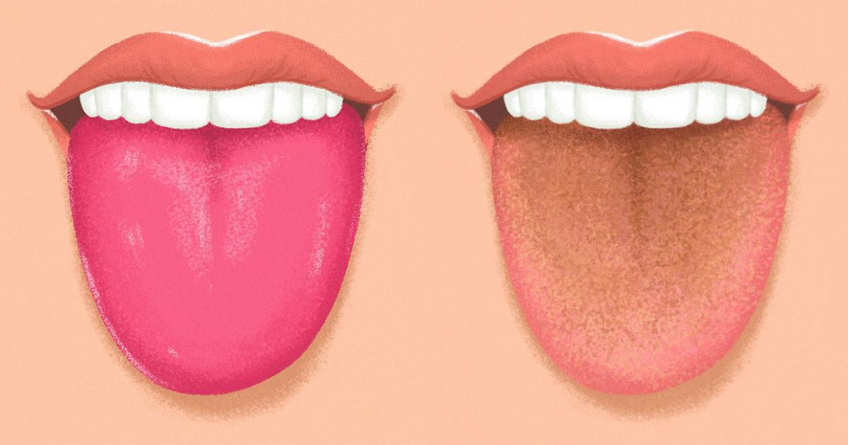Yellow language - the reasons for this phenomenon, which means the appearance of