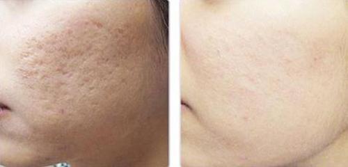 Lấp đầy vết sẹo rỗ chỉ bằng rau má và vitamin E giá chưa đến 20 nghìn! - Hình 1