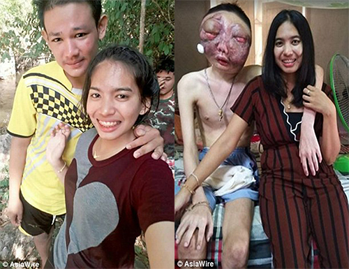 Cảm động cô gái nhất quyết ở bên bạn trai bị ung thư biến dạng mặt - Hình 1