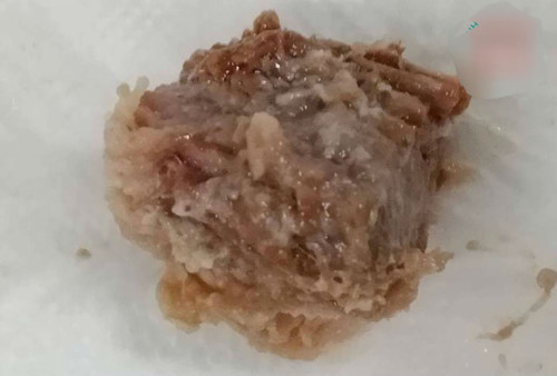 Ăn bún bò, bị cục gân bò 5 cm chắn đường thở - Hình 2