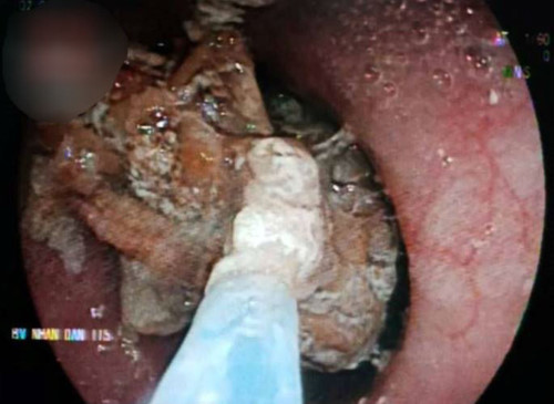 Ăn bún bò, bị cục gân bò 5 cm chắn đường thở - Hình 1