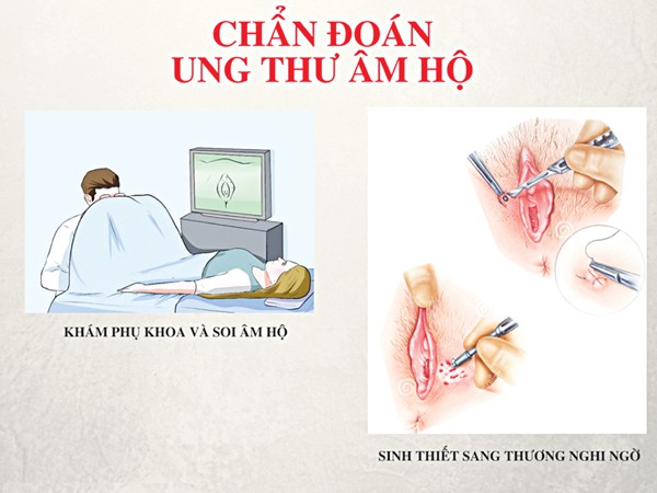 tuong chi la soi long moc nguoc vo hai o vung kin ai ngo lai la dau hieu cua benh ung thu hiem gap ccb654