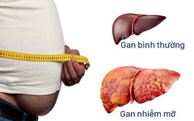 Bệnh gan nhiễm mỡ không do rượu: Nguyên nhân và cách điều trị - Hình 1