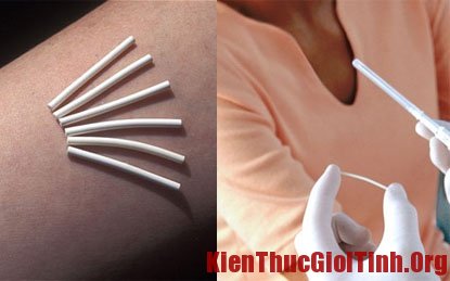 Dùng que cấy tránh thai có làm mất kinh không? - Hình 1