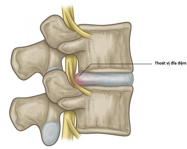 Thoát vị đĩa đệm là gì? Triệu chứng và nguyên nhân bệnh - Hình 2