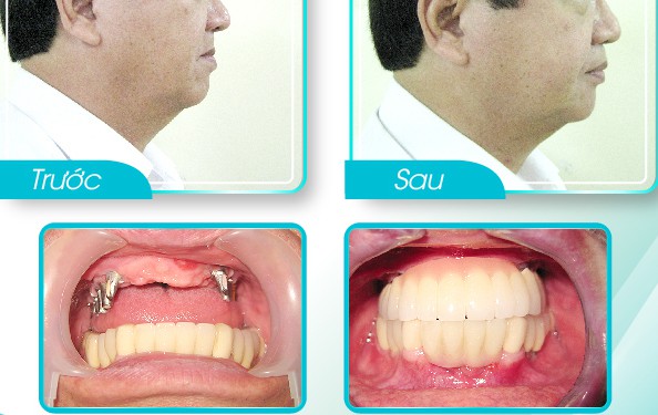 nhung dieu can biet khi trong rang implant b50493