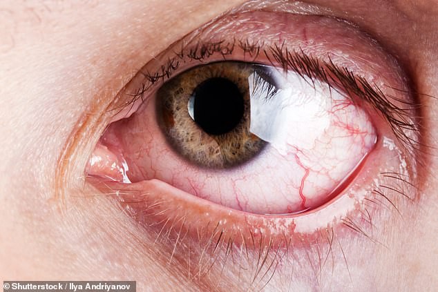 9 dấu hiệu bất thường trên đôi mắt cảnh báo bệnh tật nguy hiểm - Hình 4