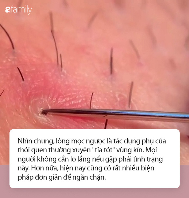 long moc nguoc xuat hien gan vung kin noi am anh cua nhieu chi em va bien phap loai bo tinh trang nay 88fe79