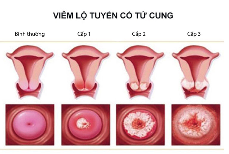 Viêm âm đạo có nguy hiểm không? Có tự khỏi được không? - Hình 1