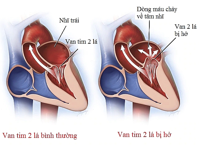 ho van tim 2 la va cac bien chung nguy hiem can phai biet 0a3055