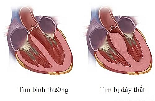 ho van tim 2 la va cac bien chung nguy hiem can phai biet cd83d8