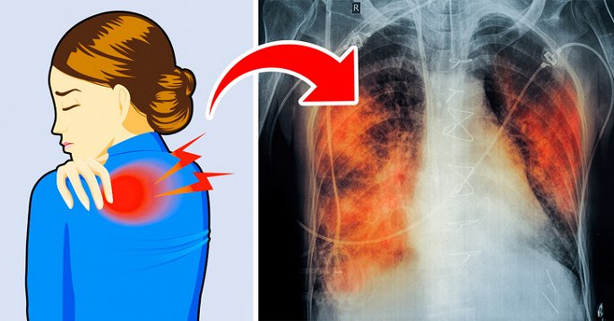 5 dấu hiệu của bệnh ung thư phổi nhiều người thường bỏ qua - Hình 1