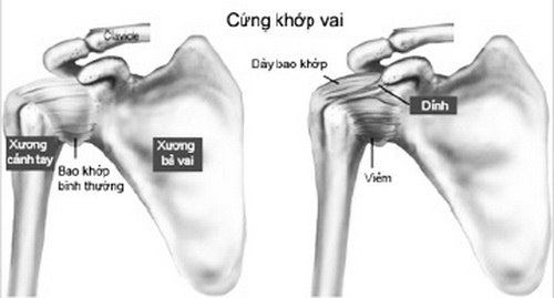 Đông cứng khớp vai và biện pháp chữa trị - Hình 1