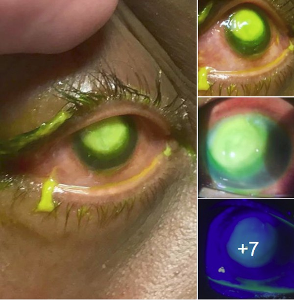 Những bức ảnh đáng sợ này chắc chắn sẽ khiến bạn nghĩ lại nếu trót lỡ đeo lens khi đi ngủ - Hình 1