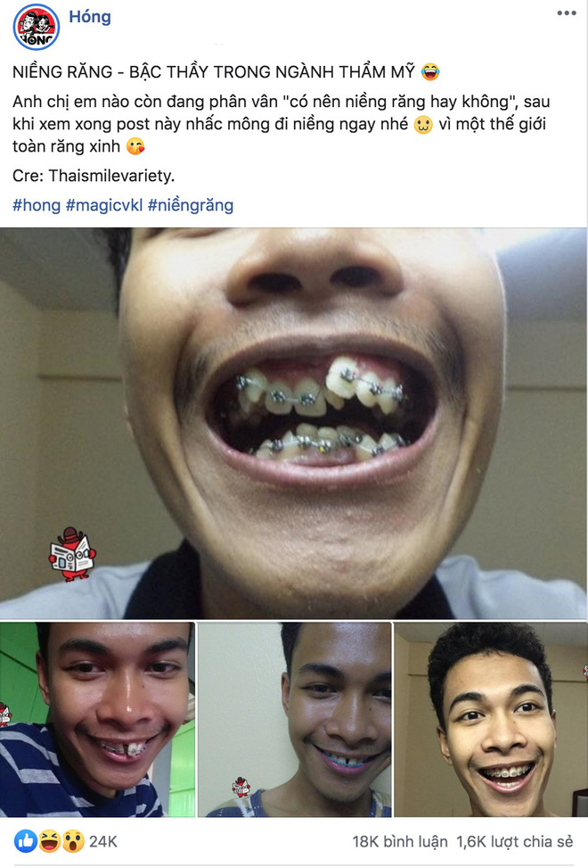 Sau pha niềng răng chấn động MXH, nhiều bạn trẻ không ngại chia sẻ hình ảnh  vịt hoá thiên nga với hàm răng của mình - Netizen - Việt Giải Trí