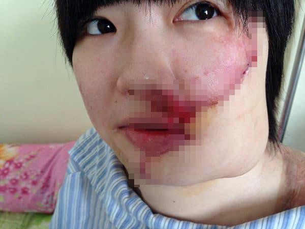 Cô gái xinh đẹp bị tạt axit và 20 lần phẫu thuật lấy lại diện mạo - Hình 1
