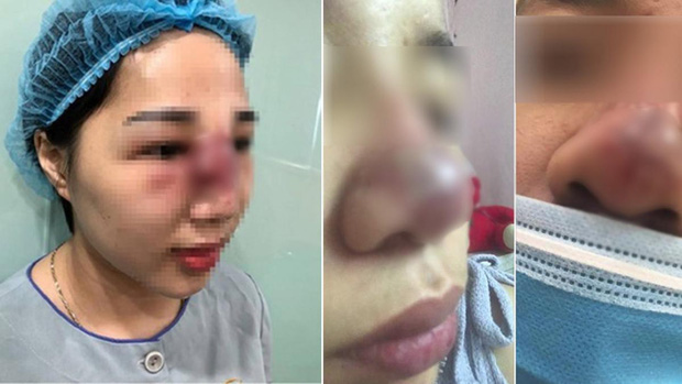 Vì sao thời nay nhiều người chọn tiêm thẩm mỹ thay vì phẫu thuật thẩm mỹ? - Hình 6