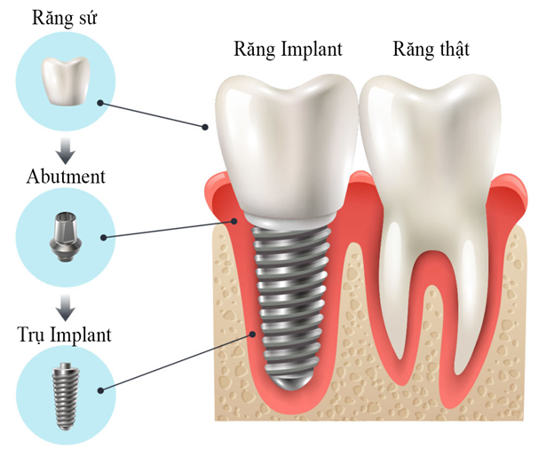 quy trinh 7 buoc phau thuat cam ghep implant theo tieu chuan vo trung 96182e