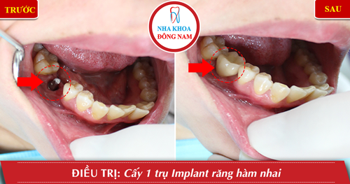 quy trinh 7 buoc phau thuat cam ghep implant theo tieu chuan vo trung ab8ed4