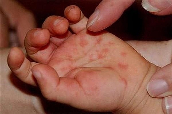 Hà Nội: Lo ngại dịch tay chân miệng tăng nhanh - Hình 1