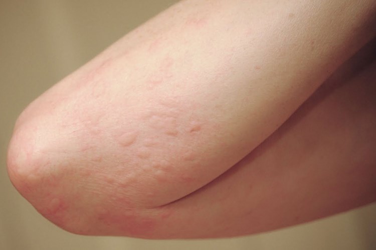 Trẻ bị mẩn ngứa, kiêng ăn gì? - Hình 1