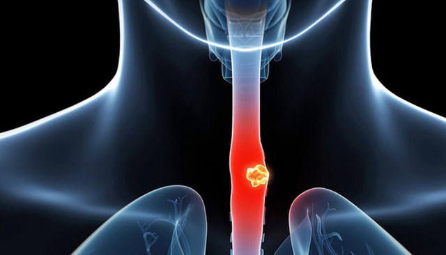Chấm dứt ngay 5 thói quen ăn uống này nếu không muốn bị ung thư thực quản - Hình 1